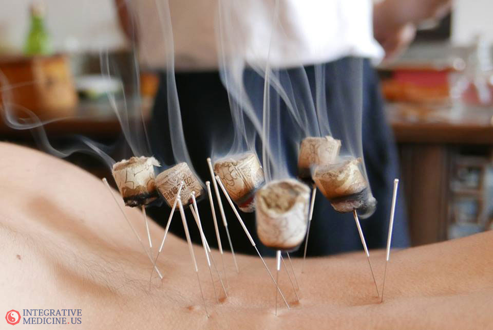 How Effective is Acupuncture for Back Pain? See what the studies say