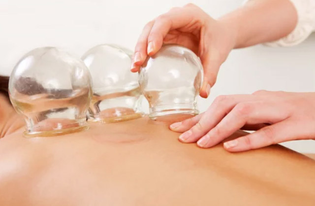 cupping therapy in coral springs